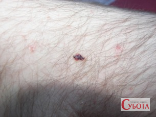 Вишнева ангіома — невелике червоне судинне утворення на шкірі